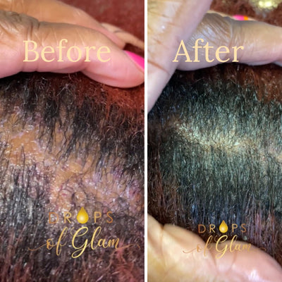 Scalp Refresher - Bundles and Drops of Glam
